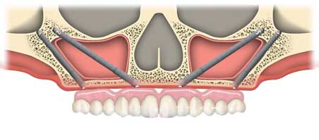 Zygoma implants - Your last resort for permanent teeth?