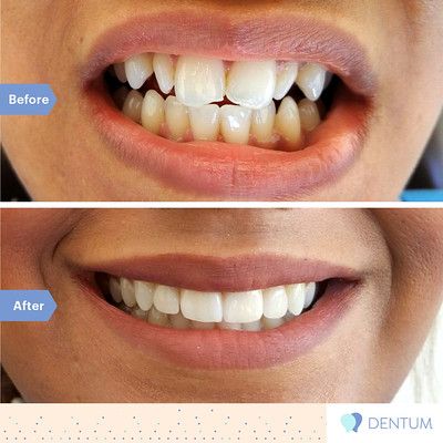 The difference between veneers and crowns – which is the better option for you?
